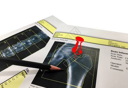 Hip和SpineBone矿藏密度BMDDEXA时空测距扫描Osteopenia存在图片