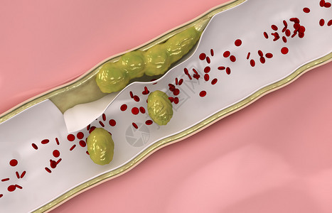 冠胆固醇通过循环系统图片