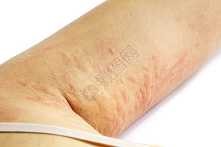 患者手臂过敏皮疹肤图片