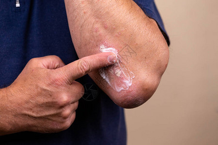 使用软膏作为药物剂型治疗皮肤病的概念照片患者在肘部区域特写的皮肤上引起医学治疗软膏稠度背景图片