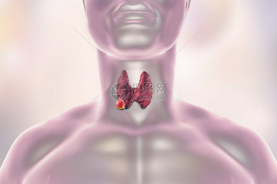 甲状腺癌3D图解显示人体内图片