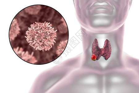 甲状腺癌3D图解显示甲状腺人体内肿瘤和甲状腺图片