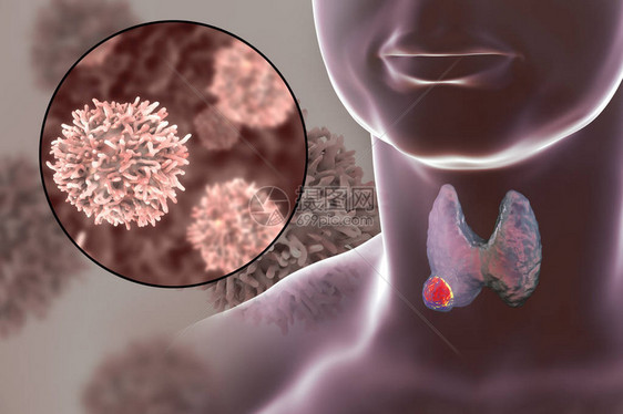 甲状腺癌3D图解显示甲状腺人体内肿瘤和甲状腺图片