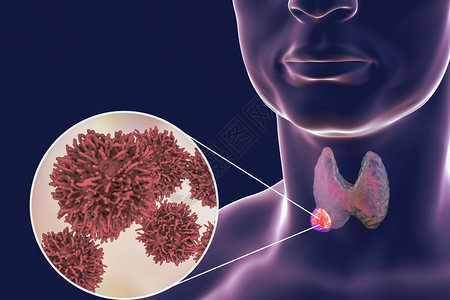 甲状腺癌3D图解显示甲状腺人体内肿瘤和甲状腺图片