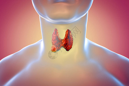 甲状腺癌3D图解显示人体内图片