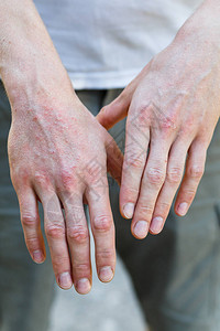皮肤上带有斑块皮疹和补丁的男子手掌上的血吸虫病粗俗自动图片