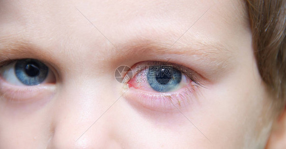 儿童眼结膜炎眼科疾病红眼睛血管在眼中爆图片