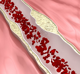 冠状动脉粥样硬化病图片