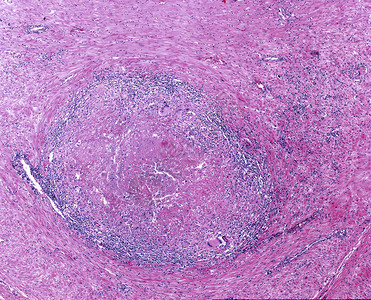 具有中心坏死慢坏死淋巴细胞渗透和多核Langhans细胞的图片