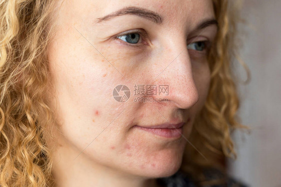 对皮肤有问题的年轻美女的肖像皮肤护理概图片