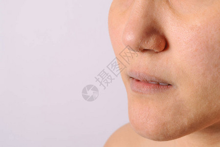 过敏女在冬季特写时有湿疹干燥的鼻子和嘴唇图片