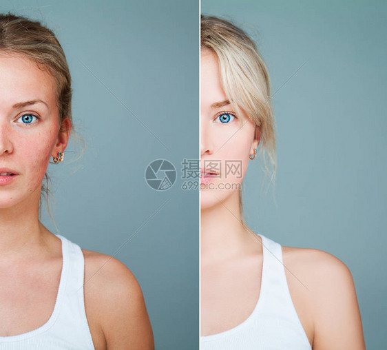 健康和不健康的皮肤概念有皮肤问题的年轻模特女人面部护理护肤医图片