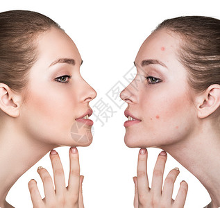 女皮肤问题治疗前后对比图图片