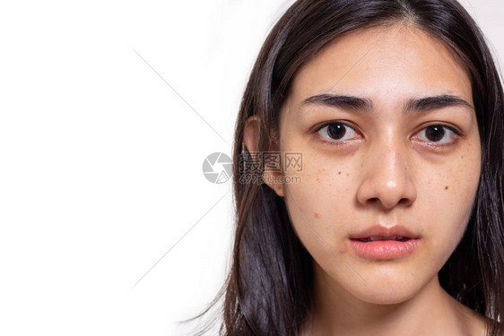 亚洲女人脸上有雀斑瑕疵粉刺和暗沉的皮肤图片
