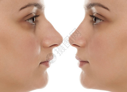一名年轻妇女鼻子手术前后和前后的图片