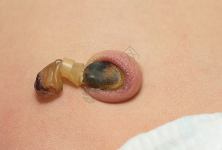 新生腹部的脐带干残端图片