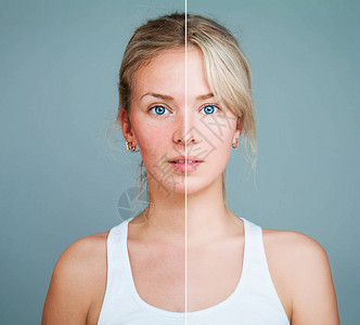 有皮肤问题的年轻模特女人女脸分为健康和不健康两部分面部护理医图片