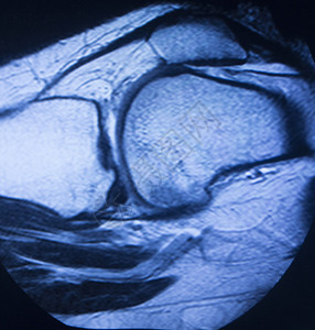MRI磁共振成像医学扫描测试结果显示膝关节半月板股骨大腿和小腿韧带软骨和人体骨骼图片