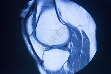 MRI磁共振成像医学扫描测试结果显示膝关节半月板股骨大腿和小腿韧带软骨和人体骨骼背景图片