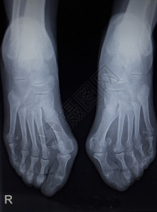X射线矫形外侧科医生APCAT对创伤医院诊所疼痛脚图片
