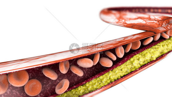 胆酯醇形成脂肪动脉静图片