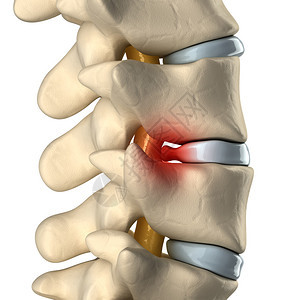 椎间盘突出图片