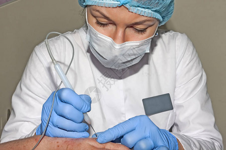 皮肤科医生用电凝器去除皮肤病图片