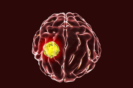 脑癌3D插图显示脑图片
