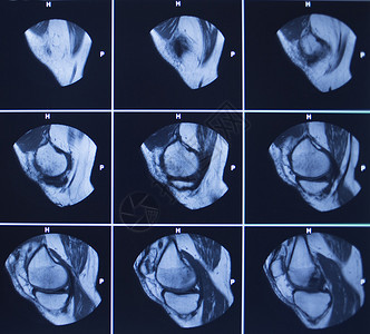 核扫描测试的结果是膝盖骨折伤照片血清图片