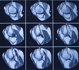 核扫描测试的结果是膝盖骨折伤照片血清背景图片