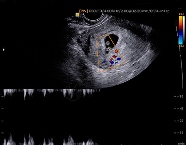 婴儿超声波图片