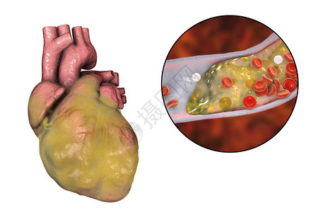 3D插图心血管疾病和天体硬化症的概念形象三维图解图片