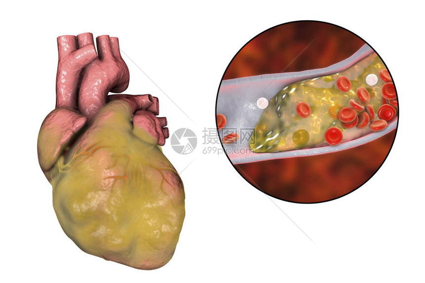 3D插图心血管疾病和天体硬化症的概念形象三维图解图片