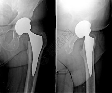 将假肢植入人的操作放射线学图片