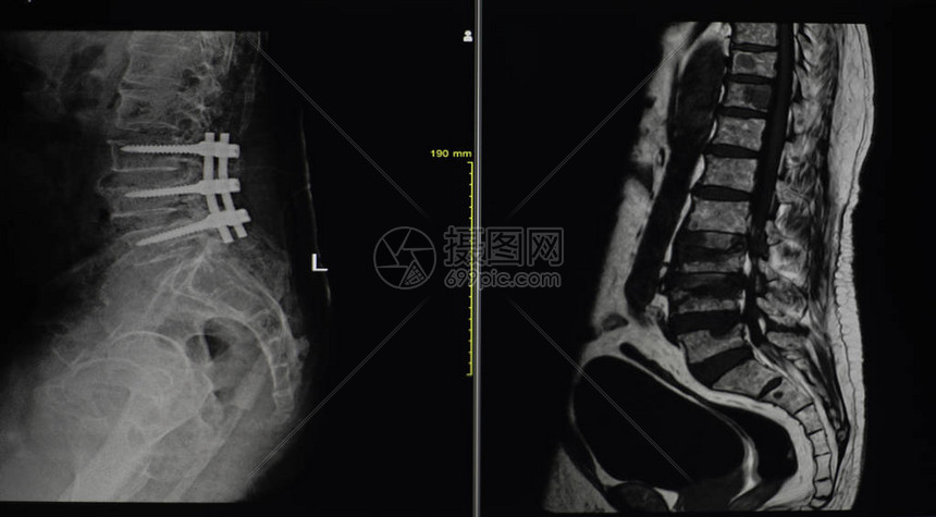 软和模糊的X射线LSspinePost固定压缩断裂L1脊椎体图片