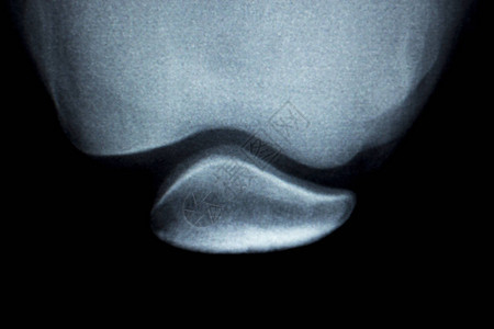 整形膝盖接合骨部颈部弯曲和软体损图片