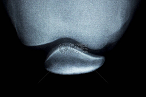 整形膝盖接合骨部颈部弯曲和软体损图片