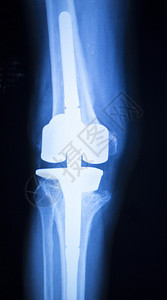 膝关节半月板X射线测试扫描结果照片显示损伤和疼痛以及整形外科和创伤外科背景图片