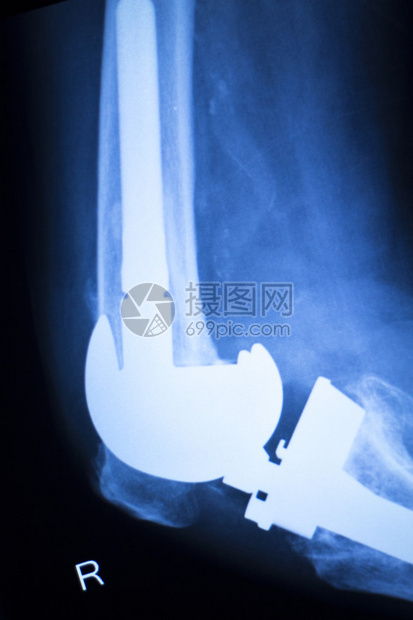 膝关节半月板X射线测试扫描结果照片显示损伤和疼痛以及整形外科和创伤外科图片
