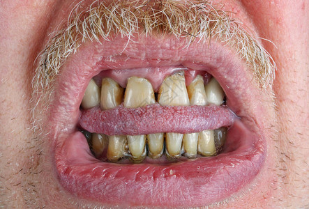 黄牙和胡子被咬舌头和干嘴唇在老年人的宏观中酒精和烟草概念的危害工图片