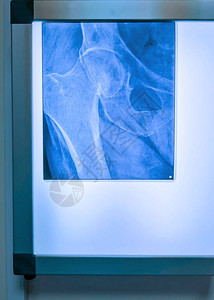 带有股骨折和骨盆质折X射线的图片