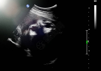 怀孕第三个月的胎儿超声怀孕第三个背景图片