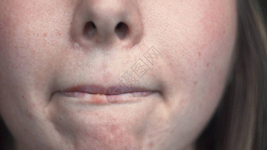 女问题皮肤与嘴唇上的疱疹的特写镜头媒体面部皮肤整洁图片