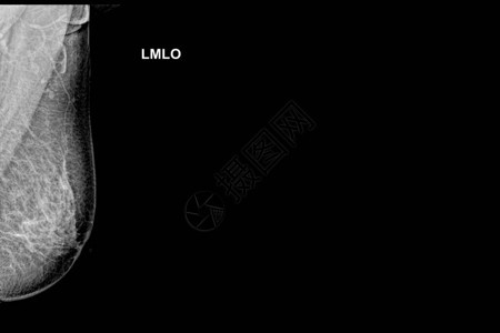 35岁以上女特殊乳房X线照片图像背景图片