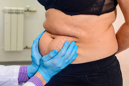 医生的手展示了女腹腔中累积的额外脂肪图片