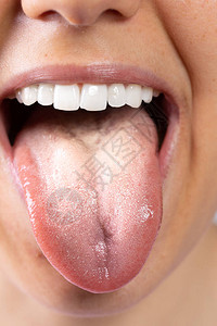 一位患有口腔念珠菌病的年轻高加索女士舌头上的特写镜头图片
