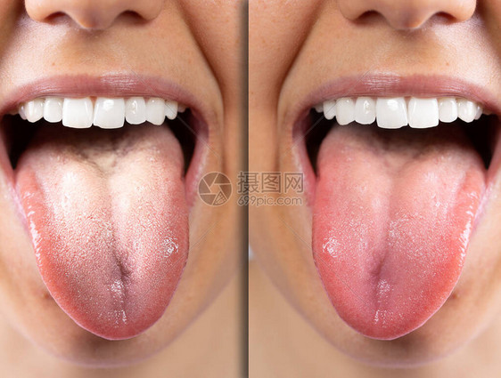 一个白人女孩舌头的前后视图图片