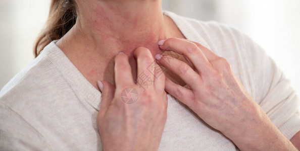 女人发痒抓挠脖子过敏症状图片