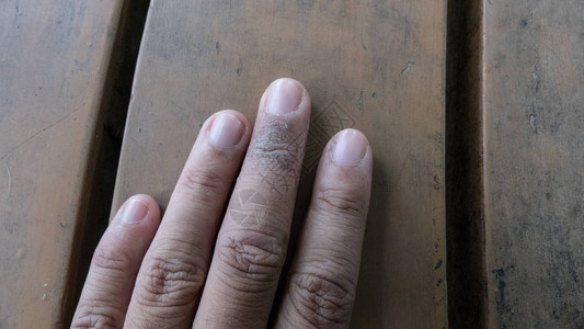寻常型银屑病真菌女手指上的湿疹图片