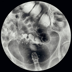 钡灌肠双重对比研究结肠直X射线图片